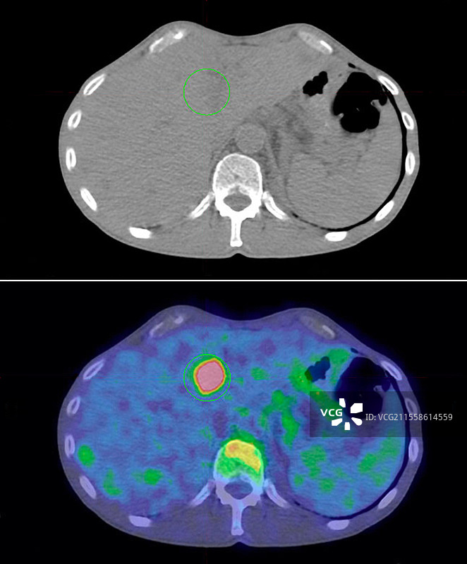 肝脏的继发性癌症，CT和PET扫描图片素材