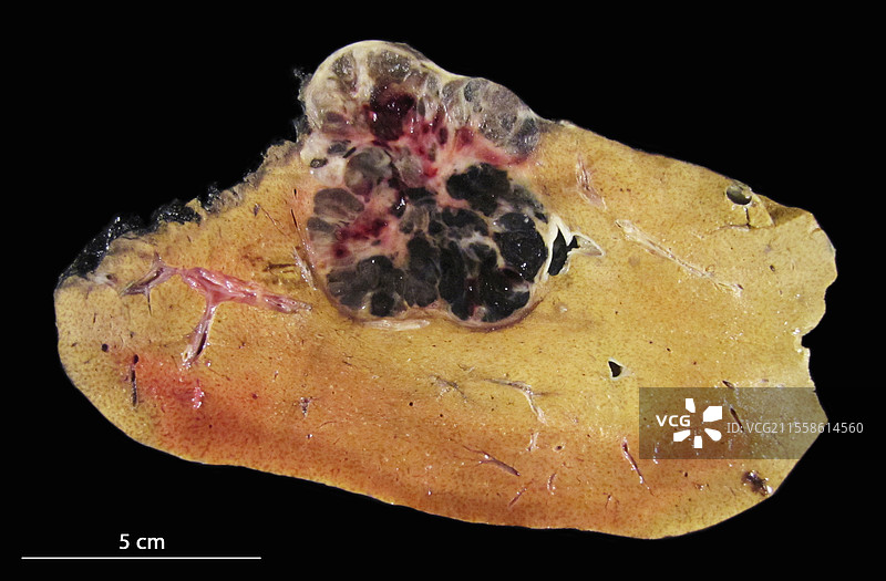 肝脏的继发性癌症，标本展示图片素材