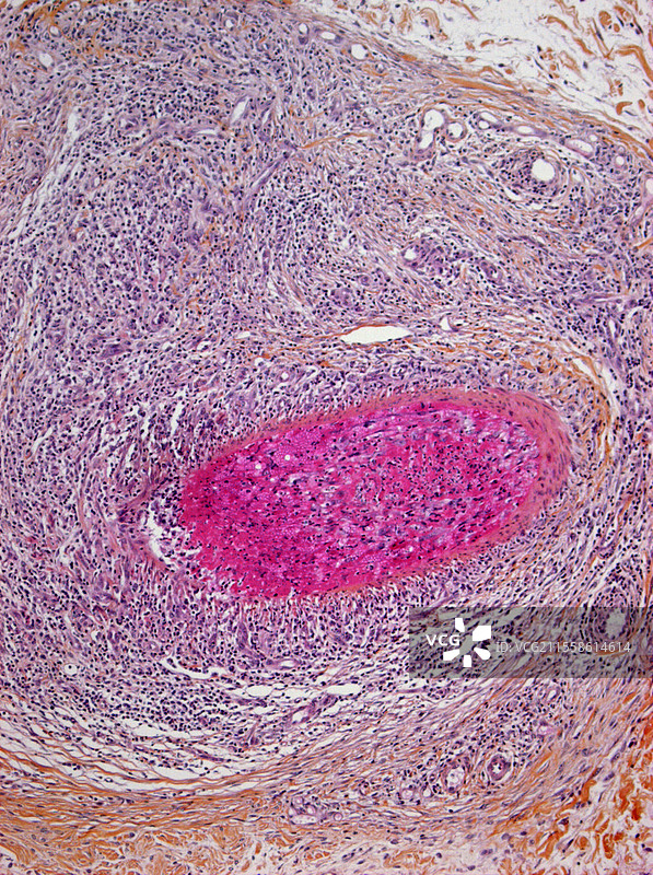 多动脉炎，光学显微镜图像图片素材