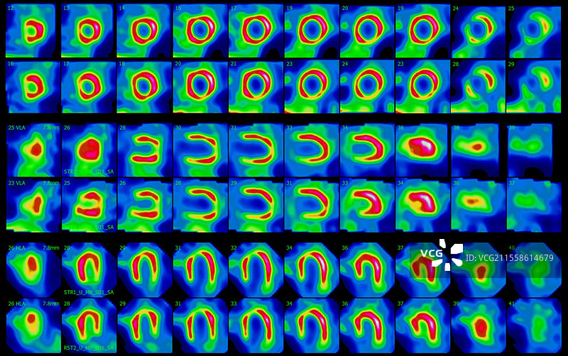 心脏病发作，SPECT扫描图片素材