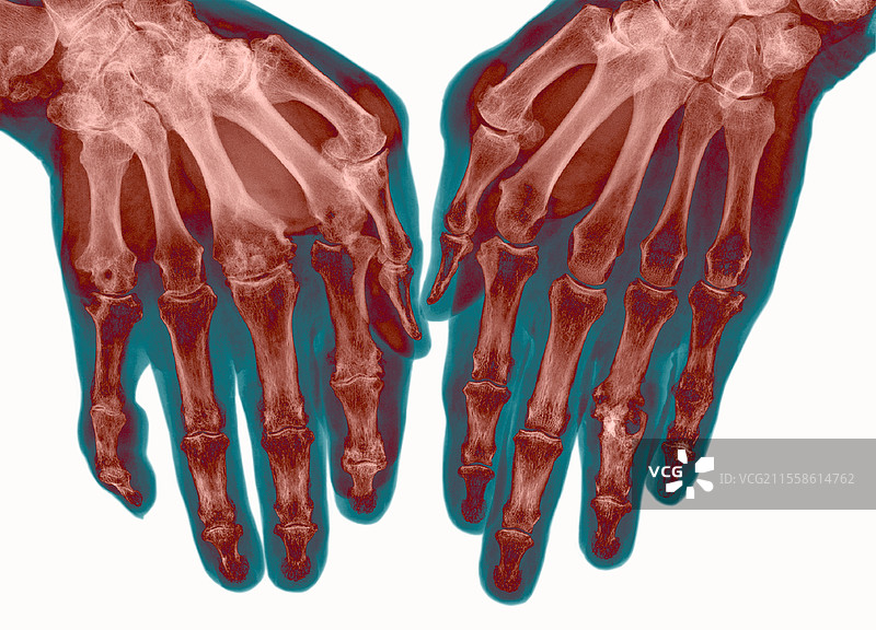 痛风，X光图片素材