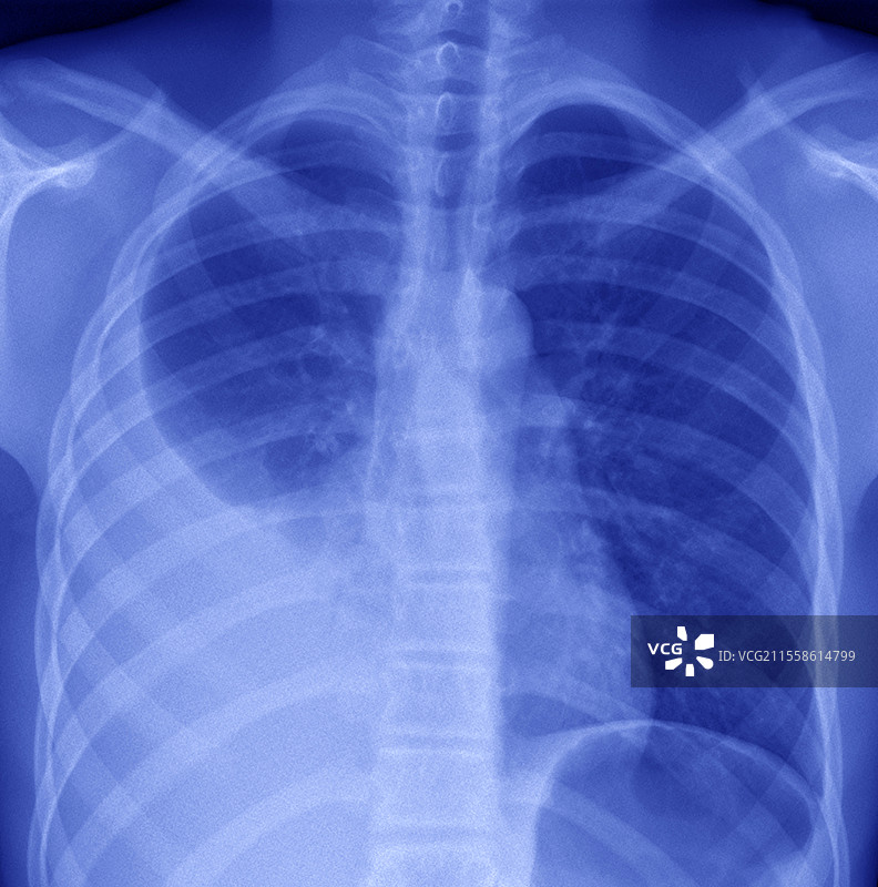 胸膜炎，X光检查图片素材