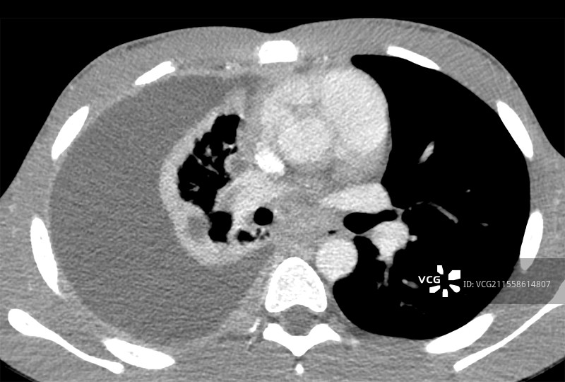 胸膜炎，CT扫描图片素材