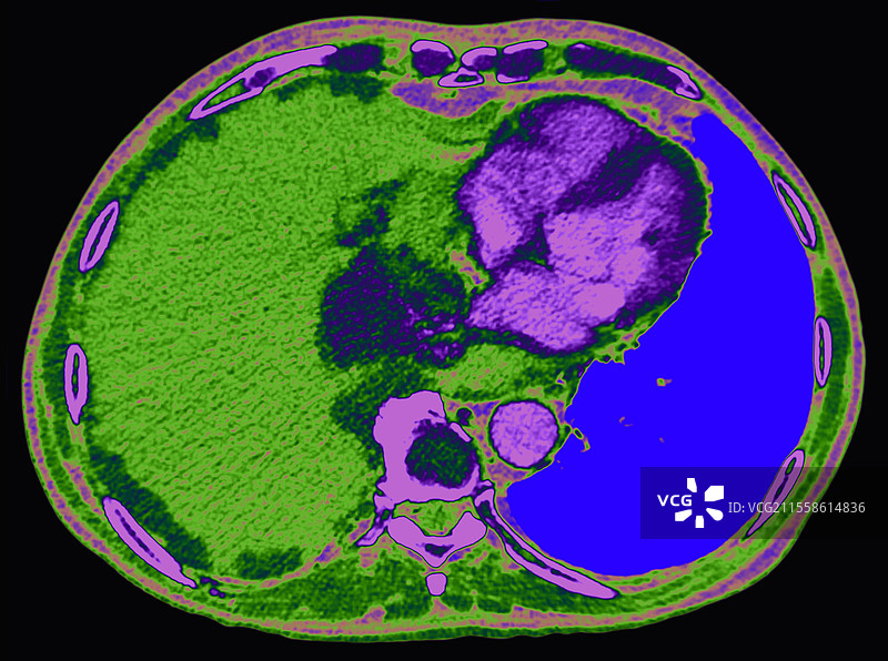 胸膜炎，CT扫描图片素材