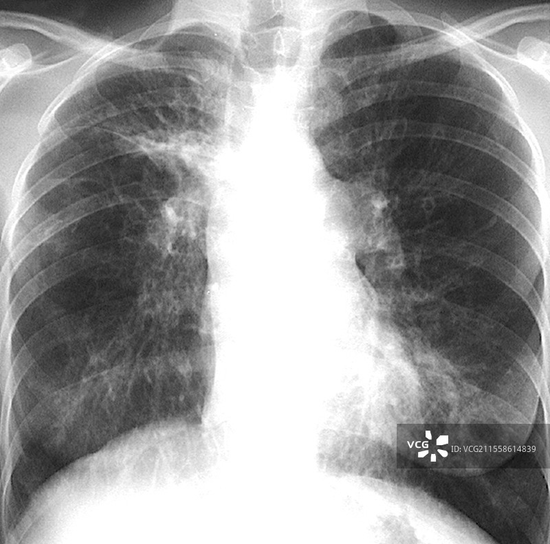 囊性纤维化，X光检查图片素材