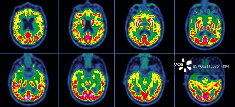 额颞叶痴呆，正电子发射断层扫描图片素材