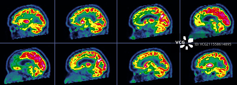 额颞叶痴呆，正电子发射断层扫描图片素材