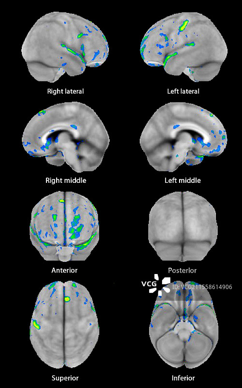 额颞叶痴呆，3D PET扫描图片素材