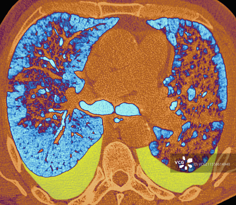 左心室衰竭，CT扫描图片素材