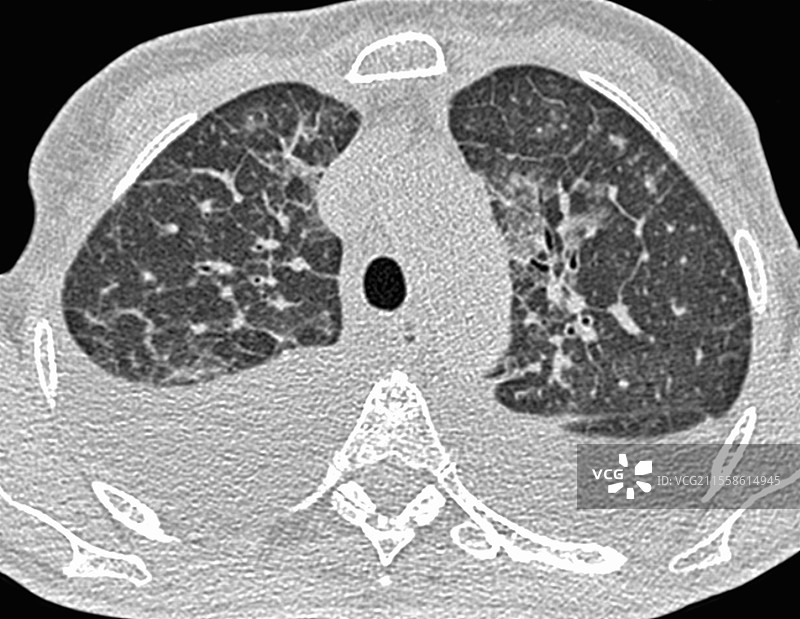 左心室衰竭，CT扫描图片素材