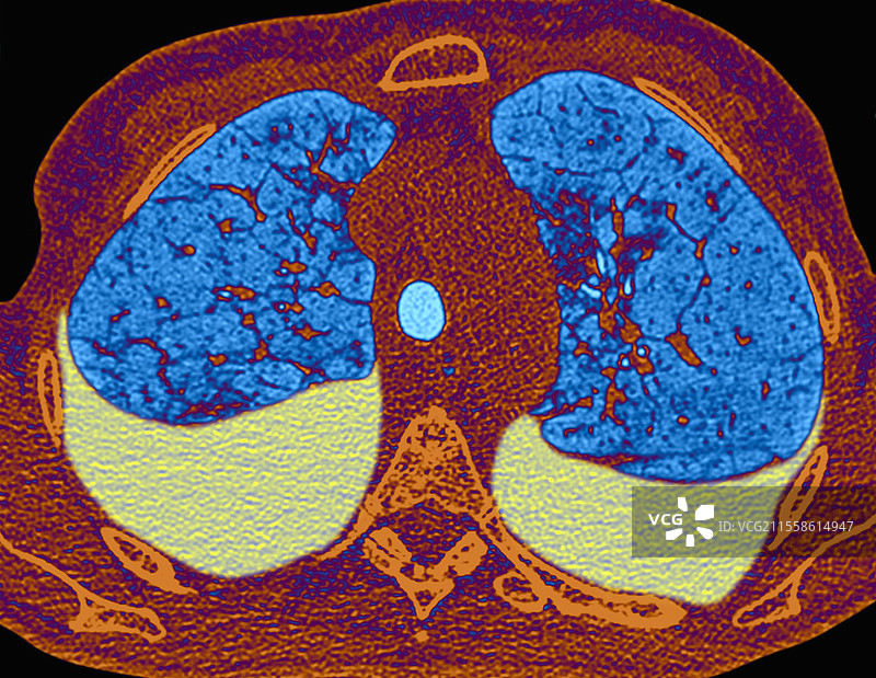 左心室衰竭，CT扫描图片素材