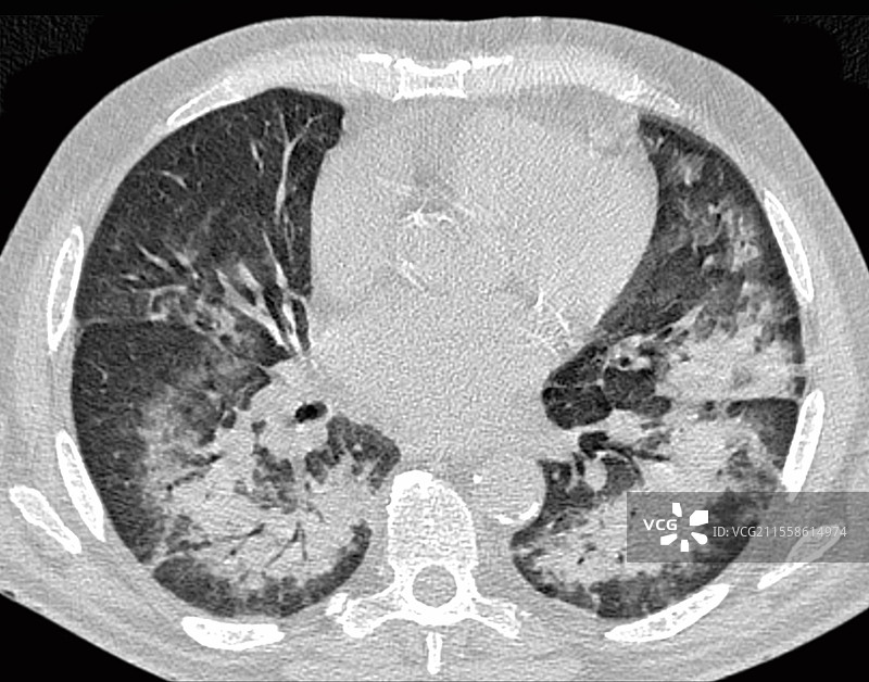 左心室衰竭，CT扫描图片素材