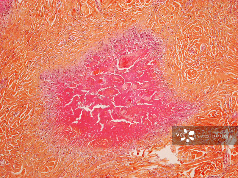 类风湿性关节炎，光学显微镜图像图片素材