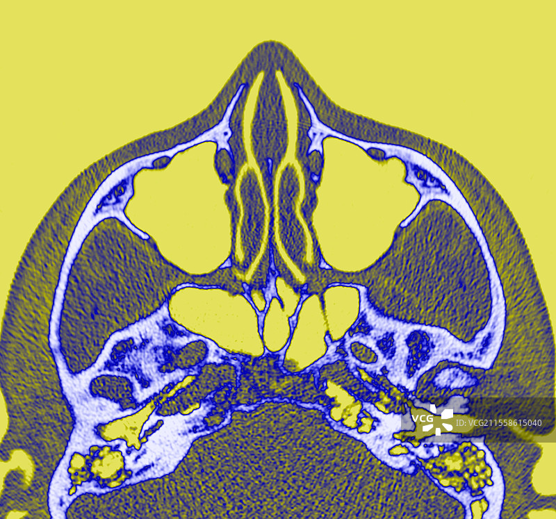 副鼻窦，CT扫描图片素材