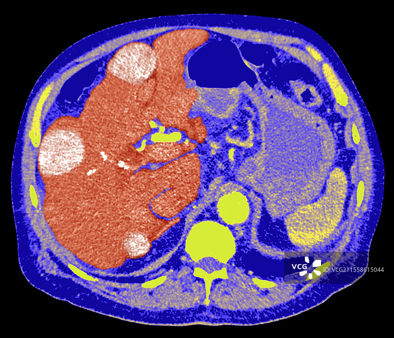 肝癌，CT扫描图片素材
