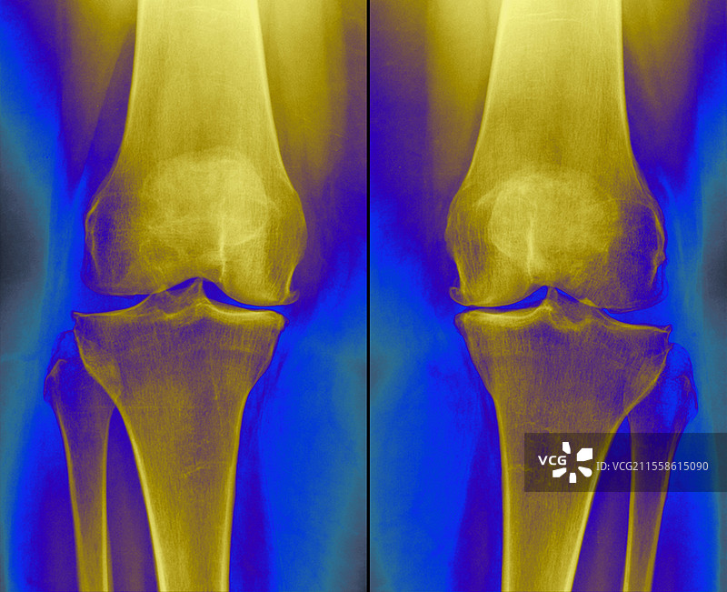 膝关节骨关节炎，X光片图片素材