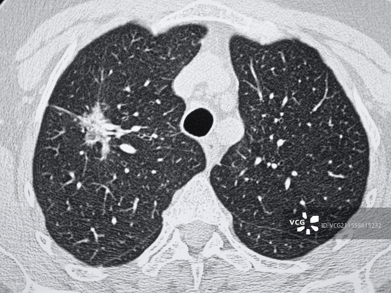 小细胞肺癌，CT扫描图片素材