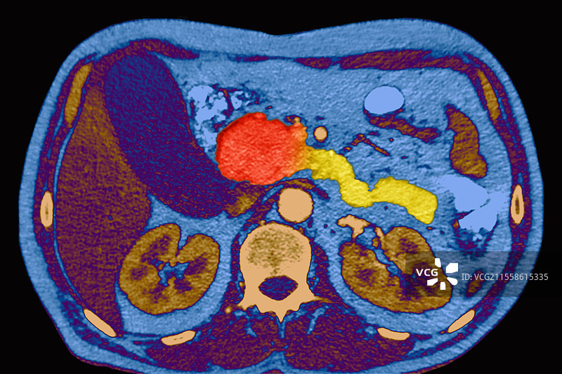 胰腺癌，彩色CT扫描图片素材