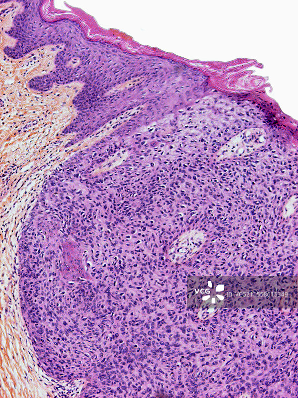 博文病，光学显微镜图像图片素材