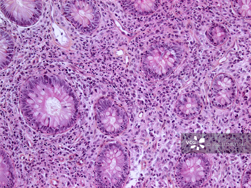 结肠肥大细胞增生，光学显微镜图像图片素材