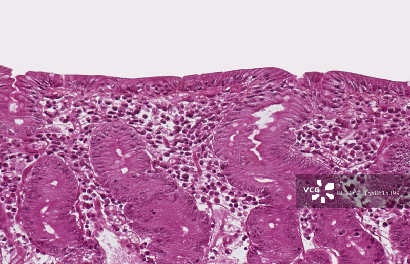 乳糜泻中的肠道，光学显微镜图像图片素材