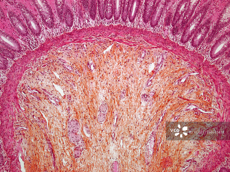 希尔施普龙病，光学显微镜图像图片素材