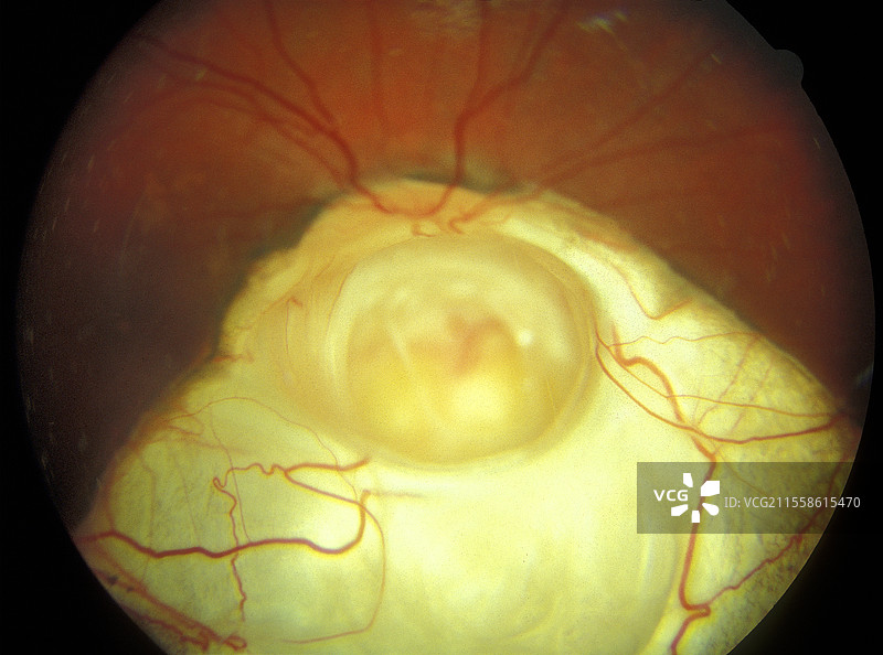 瞳孔缺损，眼底摄影图片素材