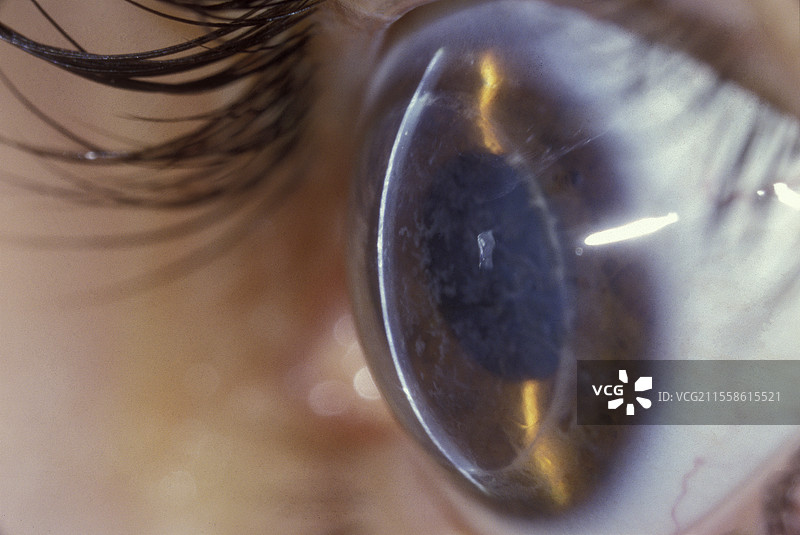 角膜营养不良在移植上的复发图片素材