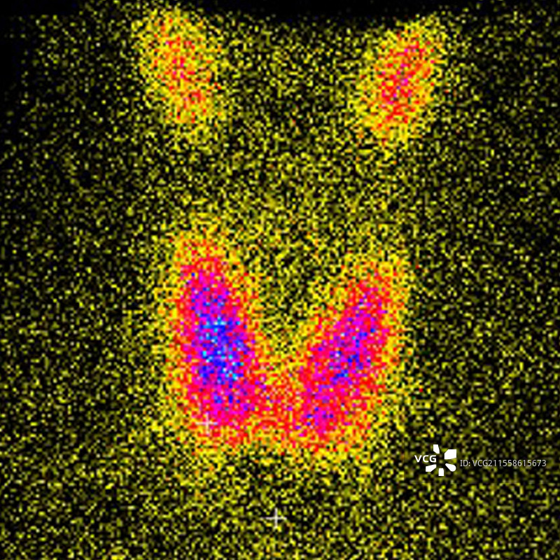甲状腺，显像图图片素材