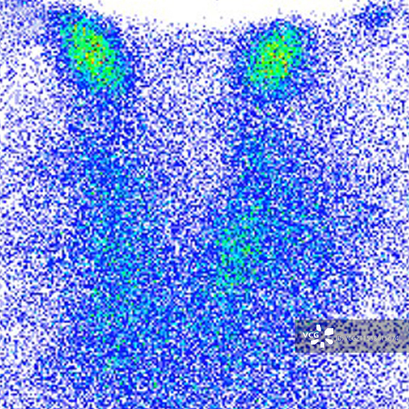 甲状腺炎，显像图图片素材