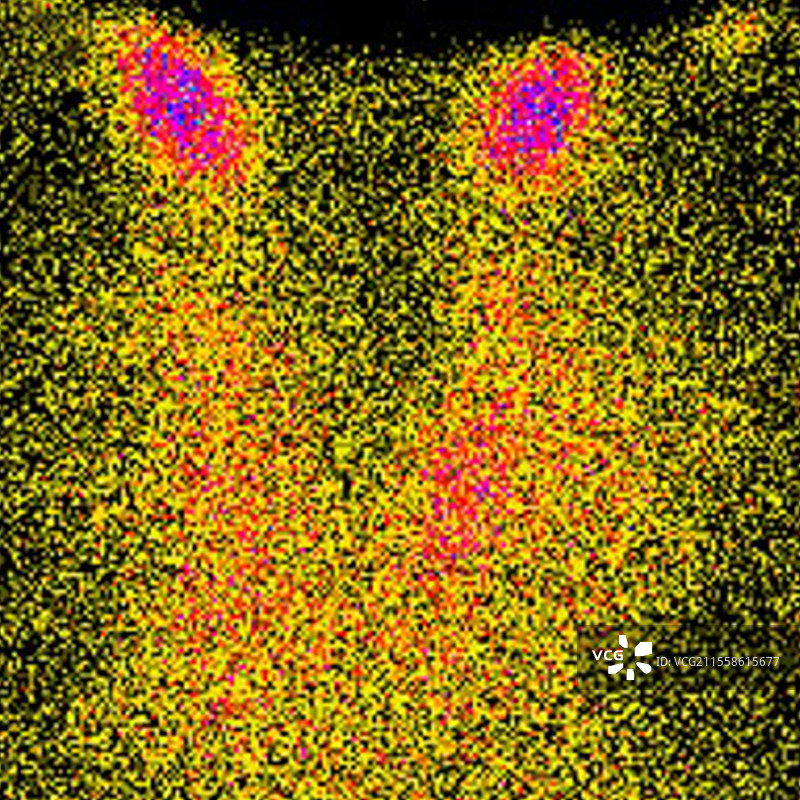 甲状腺炎，显像图图片素材