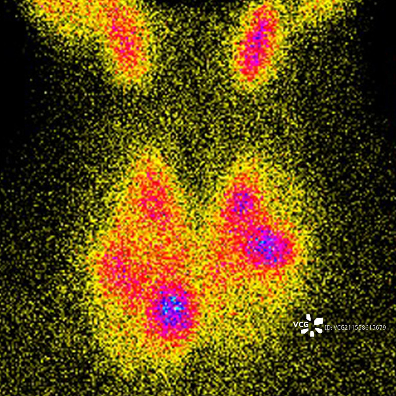 毒性多结节性甲状腺肿，显像图图片素材