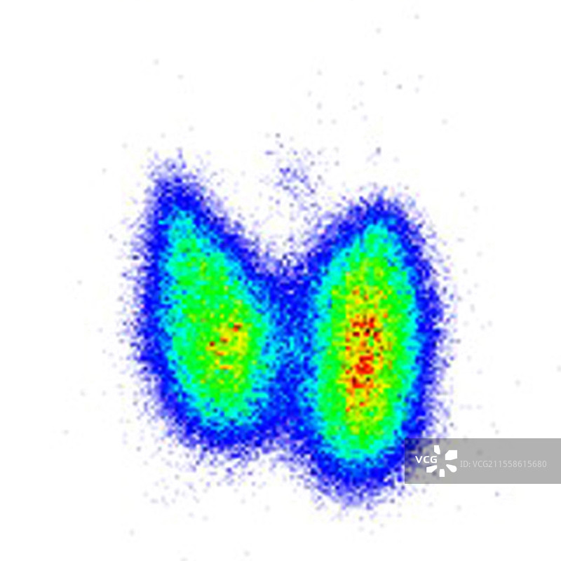 格雷夫斯病，显像图图片素材