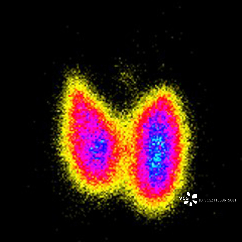 格雷夫斯病，放射性核素扫描图片素材