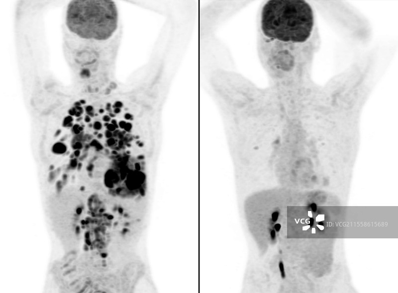 治疗前后的继发性癌症，PET扫描图片素材