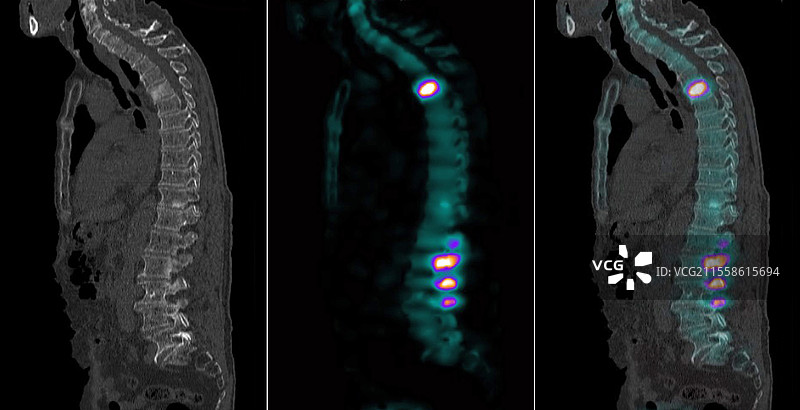 脊柱的继发性骨癌，放射性核素扫描和CT扫描图片素材