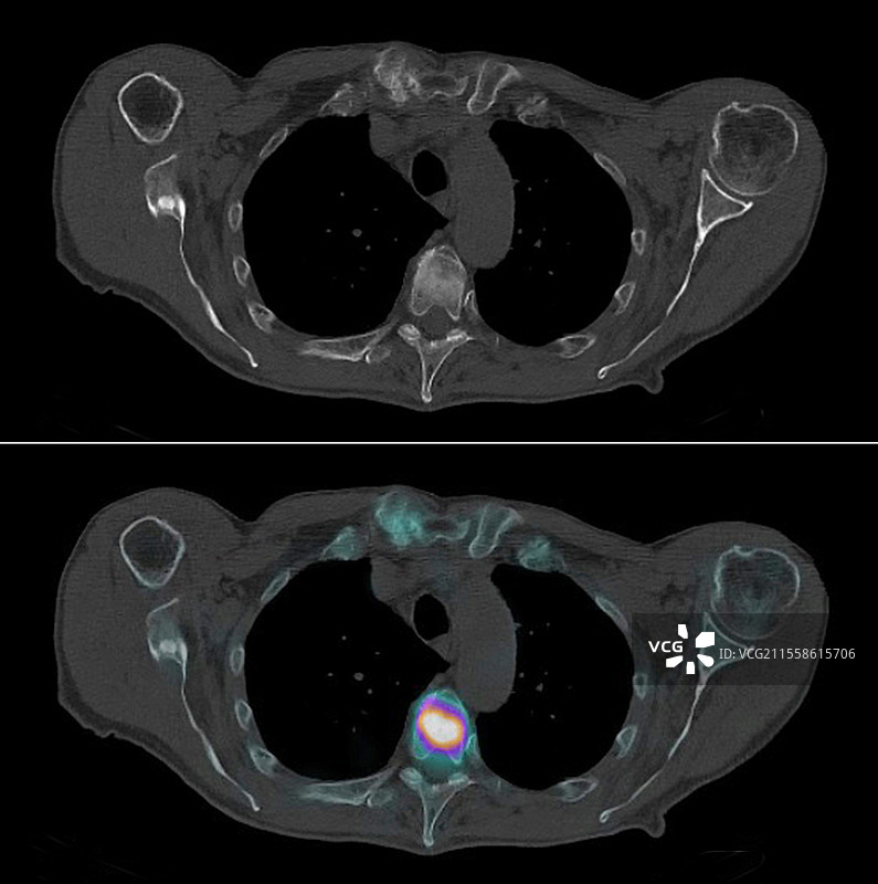 继发性脊柱癌，放射性核素扫描和CT扫描图片素材