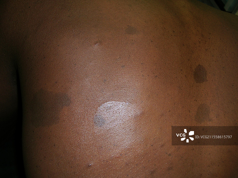 雷克林豪森病图片素材