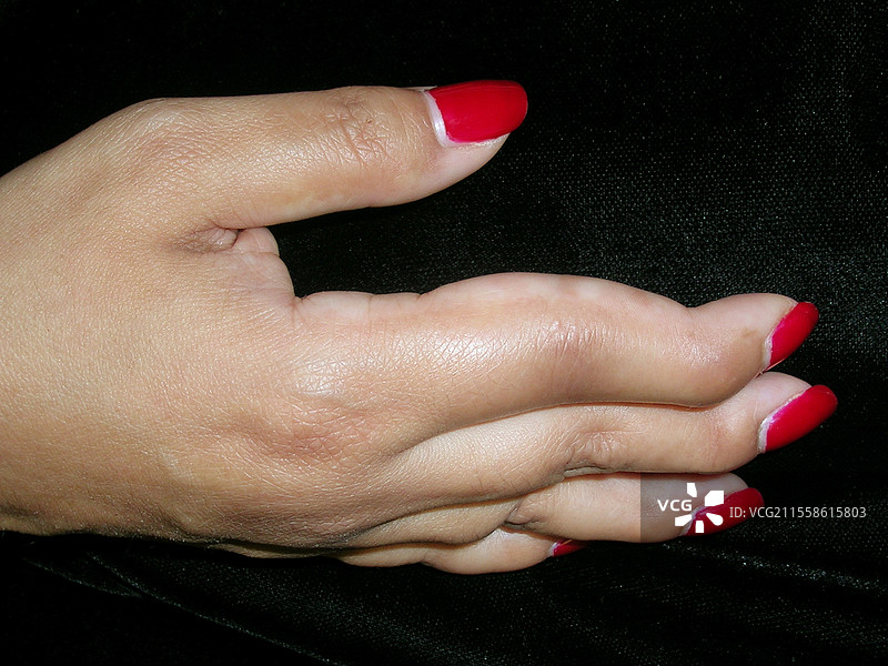 银屑病关节炎中的天鹅颈畸形图片素材