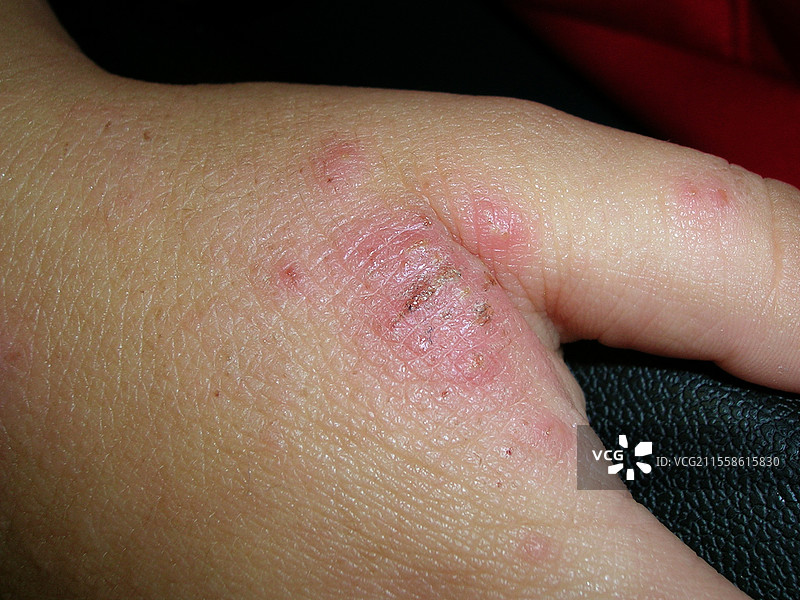 脓疱病和特应性皮炎图片素材