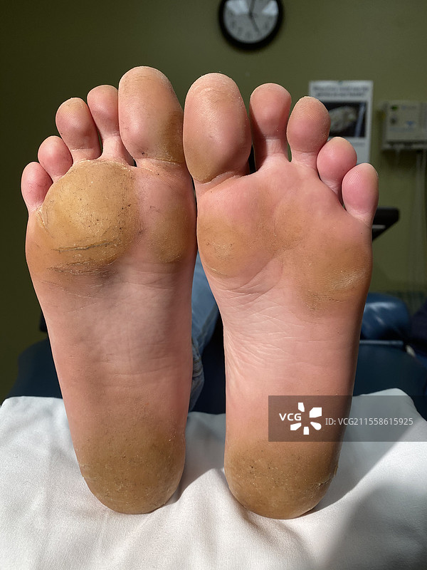 足底角化病图片素材