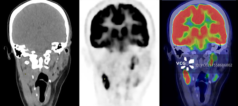 霍奇金病，CT和PET扫描图片素材