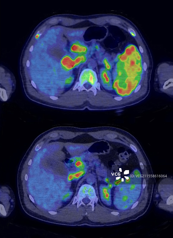 霍奇金淋巴瘤复发，CT-PET扫描图片素材