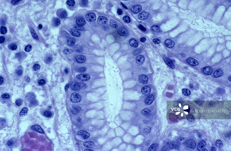 幽门螺杆菌胃炎，光学显微镜图像图片素材