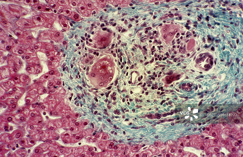 肝脏肉芽肿病，光学显微镜下图像图片素材