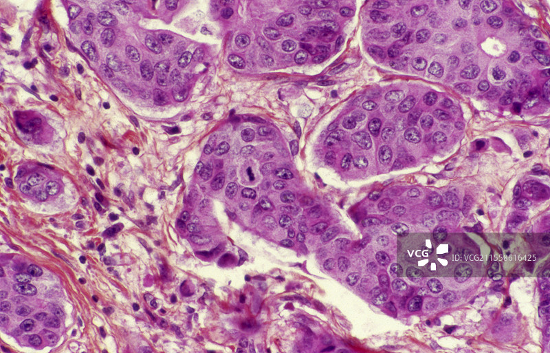 乳腺腺癌，光学显微镜图像图片素材
