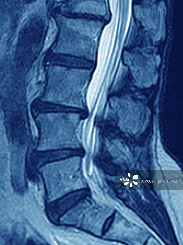 脊椎滑脱，MRI扫描图片素材