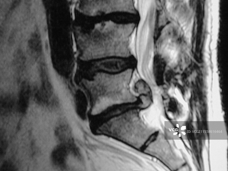 椎间盘突出，MRI扫描图片素材