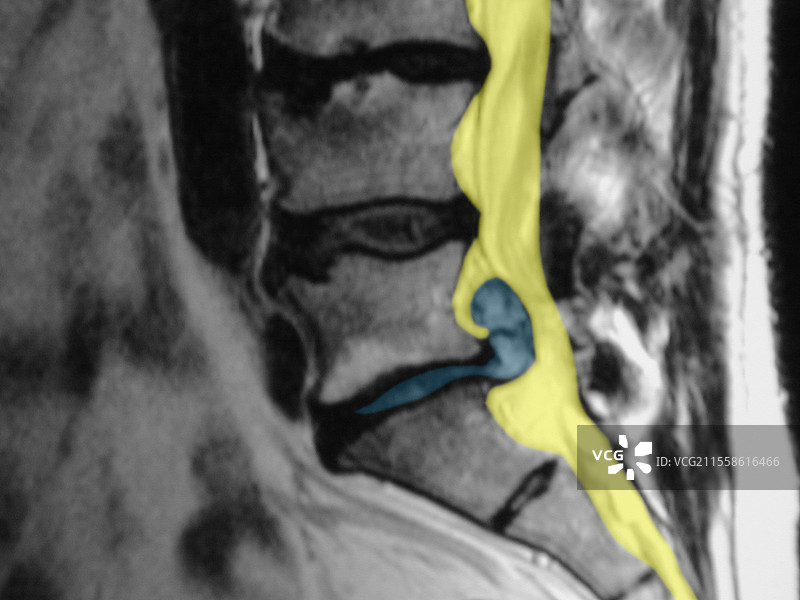 椎间盘突出，MRI扫描图片素材