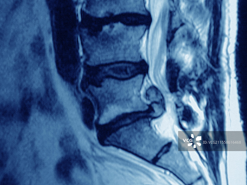 椎间盘突出，MRI扫描图片素材